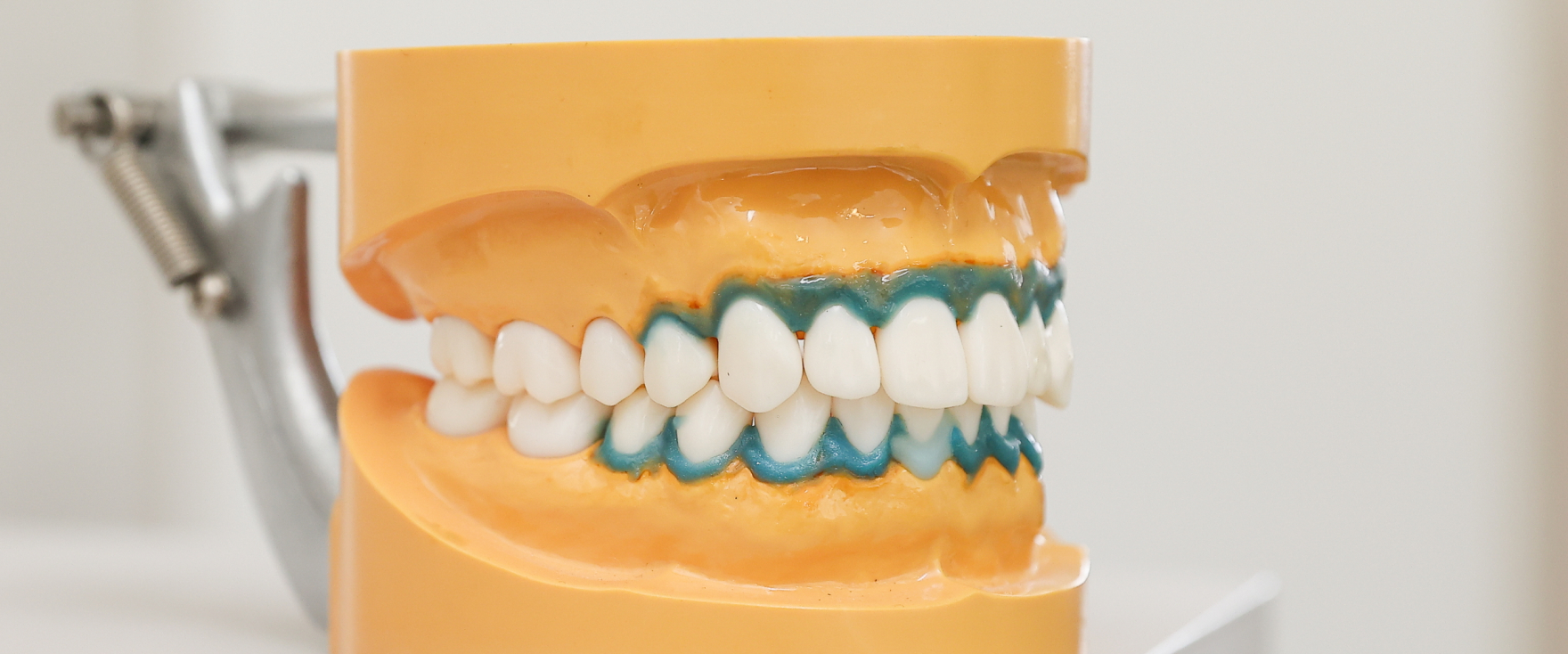 つめ物・かぶせ物